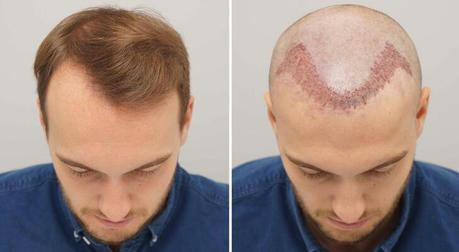 The 5 Truths About Hair Transplant Surgery: What Doctors Might Not Tell You