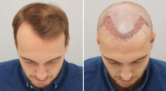The 5 Truths About Hair Transplant Surgery: What Doctors Might Not Tell You