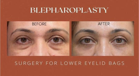 Tired Eyes or Just Droopy Lids? The Science Behind Why We Choose Blepharoplasty